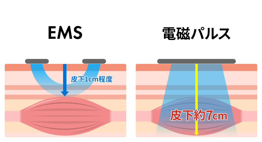 EMSでは皮下1cm程度の刺激　電磁パルスでは皮下約7cmの刺激